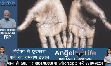 लखनऊ के अस्पतालों में मंकी पॉक्स को लेकर अलर्ट