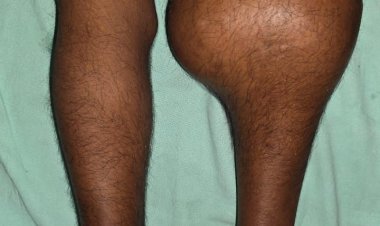 स्वरूप रानी नेहरू अस्पताल प्रयागराज में जटिल सर्जरी सफल