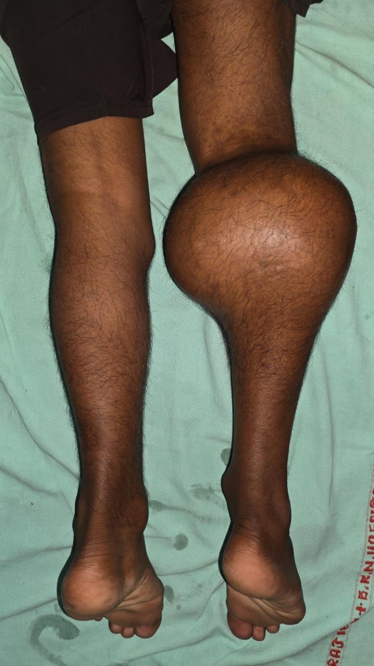 स्वरूप रानी नेहरू अस्पताल प्रयागराज में जटिल सर्जरी सफल